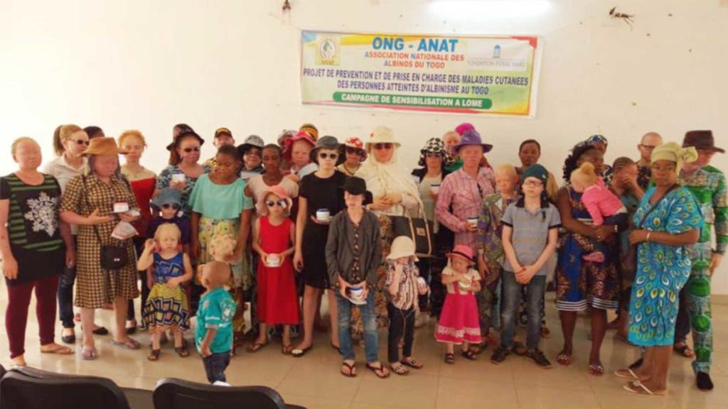 La prévention des maladies liées à l’albinisme au Togo